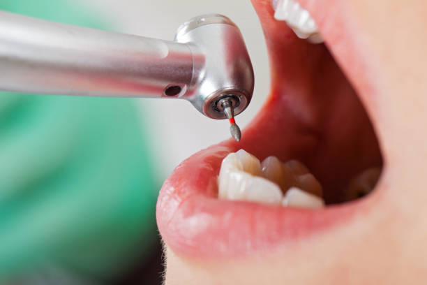 Best Emergency Dental Care for Abscessed Tooth in Hartley, CA